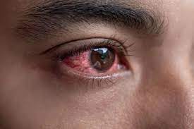How To Get Rid of Red Eyes Naturally at Home